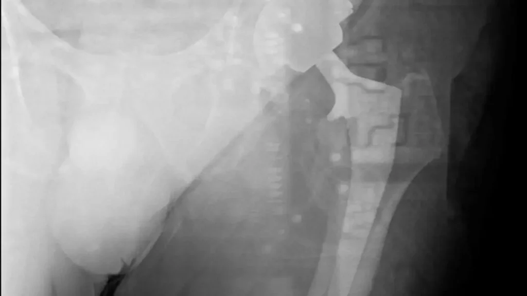 Hip X-ray showing a faint ghosted secondary image caused by backscatter radiation