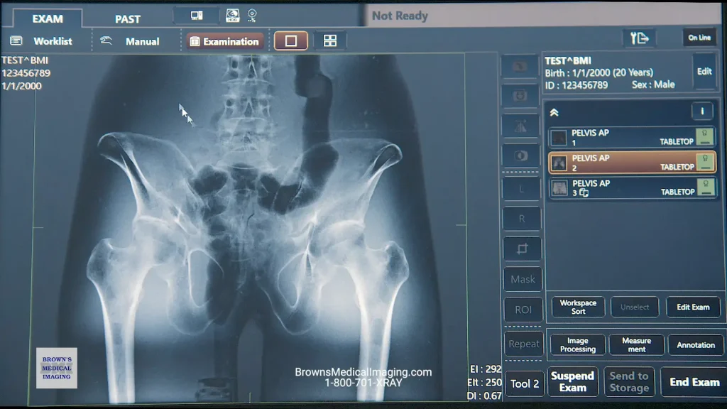 Canon CXDI control software displaying a pelvis X-ray with exam worklist panel