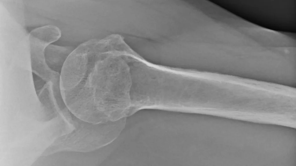 Close-up X-ray of the shoulder joint in PA axillary projection