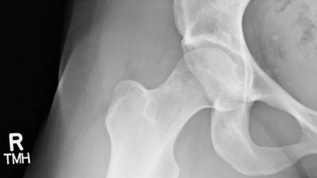 Close-up hip X-ray showing the femoral head and acetabulum