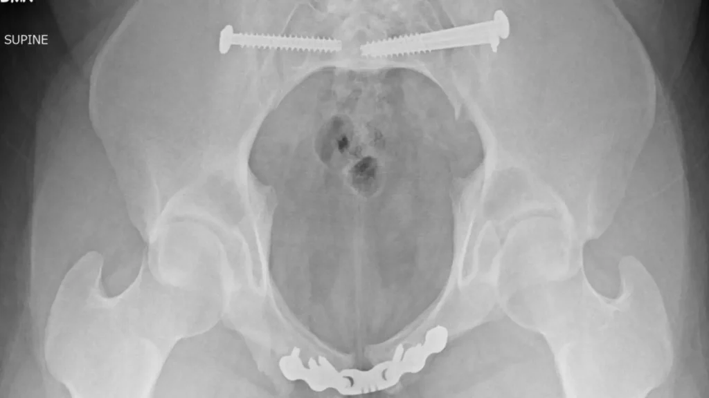 Pelvis X-ray, supine inlet view, showing surgical screws in the sacroiliac region