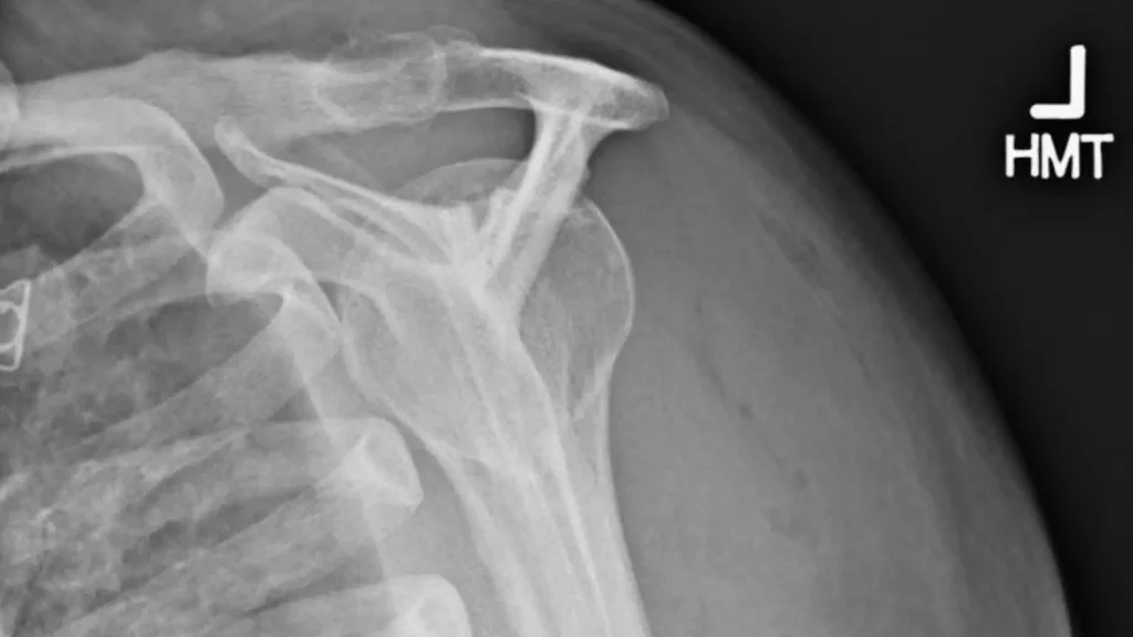 Close-up shoulder X-ray in outlet projection showing the scapula and acromion
