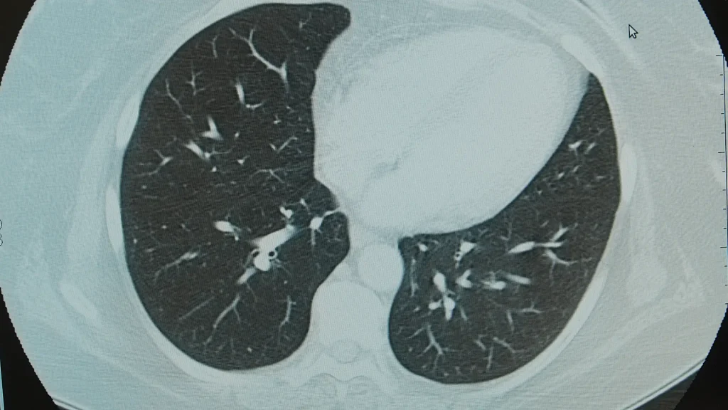 Axial CT scan image showing a cross-section of the chest with lungs and heart