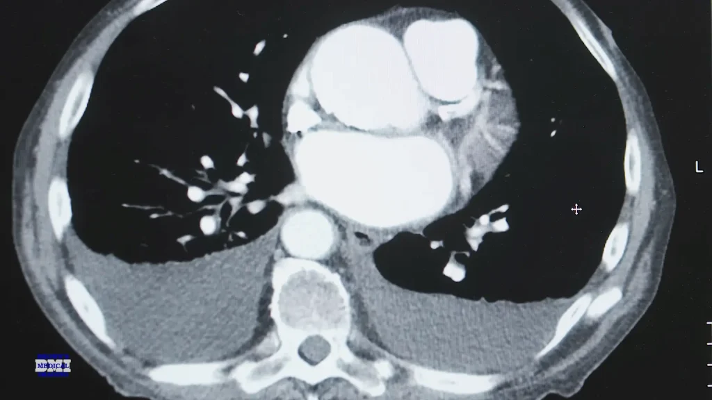 Axial CT scan image showing a cross-section of the chest with heart and lungs, with a Brown's Medical Imaging logo watermark