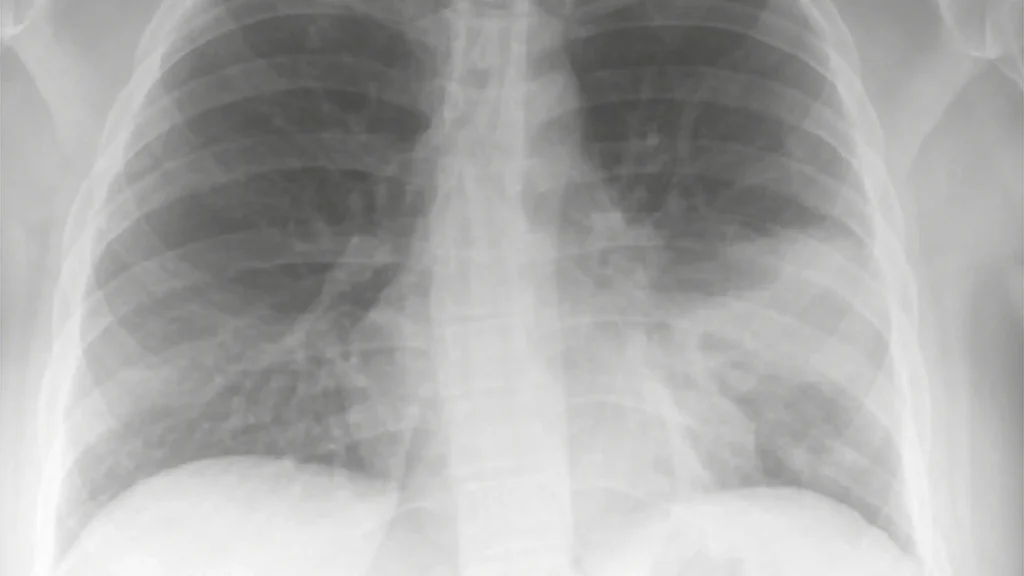 Frontal chest X-ray image showing the lungs and ribcage