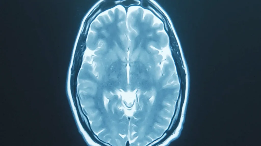 Axial MRI brain scan image in blue tones