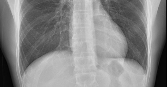 High-resolution chest X-ray sample image captured with the AeroDR HD detector