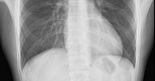 Standard-definition chest X-ray sample image for comparison with AeroDR HD's high-definition output