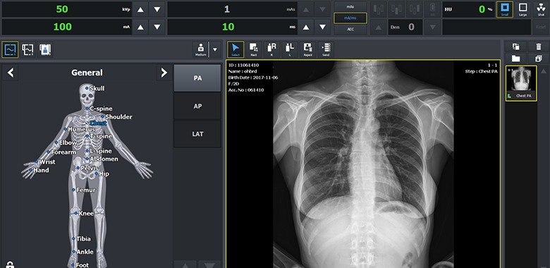 Radiography console workstation displaying a chest X-ray with anatomical selection menu