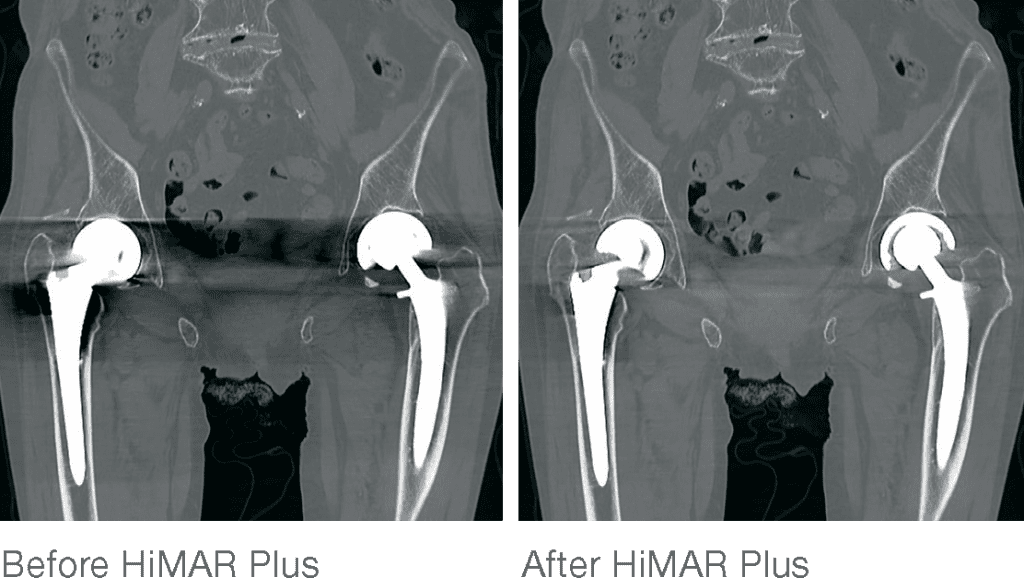 Coronal CT comparison of hip replacement implants before and after HiMAR Plus metal artifact reduction processing