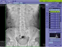 Sample pelvis and lumbar spine X-ray image demonstrating diagnostic image quality
