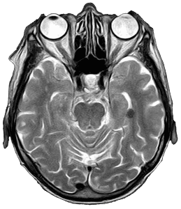 Axial MRI brain scan slice showing eyes, sinuses, and brain structures