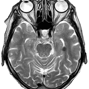 Axial MRI brain scan slice showing eyes, sinuses, and brain structures