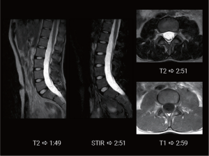 Lumbar spine MRI study showing sagittal T2, STIR, and axial T2/T1 sequences with scan times captured on the APERTO Lucent
