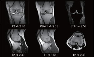 Six-panel knee MRI study showing T2, PDW, STIR, and T1 sequences with scan times captured on the APERTO Lucent