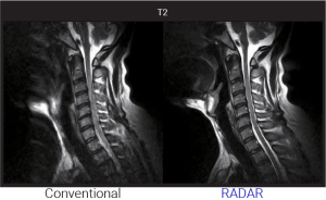 Cervical spine MRI comparison between conventional imaging and RADAR technique on a T2 sequence