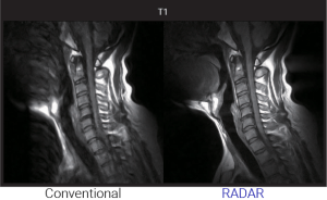Cervical spine MRI comparison between conventional imaging and RADAR technique on a T1 sequence