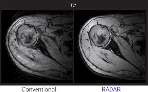 Shoulder MRI comparison between conventional imaging and RADAR technique on a T2* sequence
