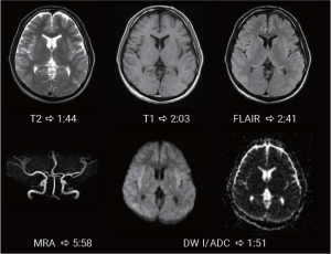 Brain MRI study showing T2, T1, FLAIR, MRA, and DWI/ADC sequences with scan times captured on the APERTO Lucent