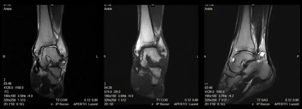 Three ankle MRI images (T2 coronal, T1 coronal, T2 sagittal) demonstrating IP RAPID reconstruction on the APERTO Lucent