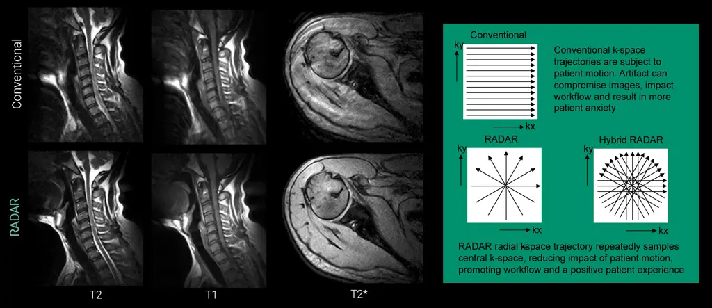 Comparison of conventional versus RADAR and Hybrid RADAR k-space imaging techniques with cervical spine and shoulder MRI examples on the APERTO Lucent