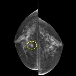 Mammogram image with a yellow circle highlighting a detected mass