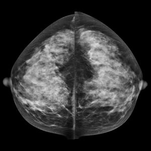Mammogram image showing breast tissue for comparison purposes