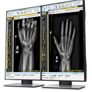 Two vertical DICOM diagnostic monitors displaying hand X-ray images