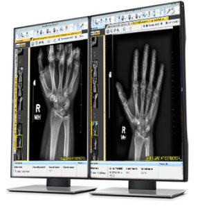 Two diagnostic monitors displaying hand X-ray images side by side