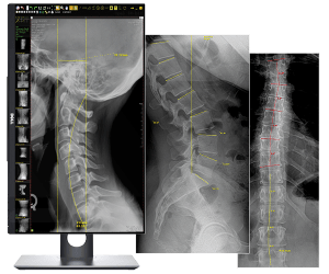 OpalRad viewer displaying spine X-ray images with measurement annotations across three monitors