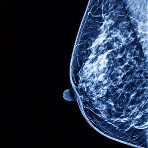 Mammography image showing a breast with a small mass highlighted, illustrating Transpara AI detection