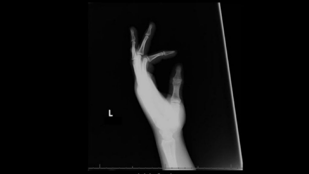 X-ray image of a hand with fingers curled, showing bones against a dark background