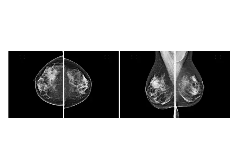 Two mammogram image pairs showing craniocaudal and mediolateral oblique breast views