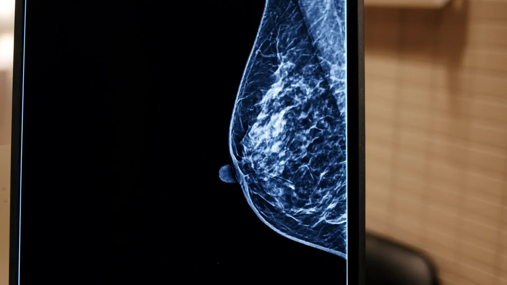 Close-up mammogram X-ray image showing breast tissue with a visible mass