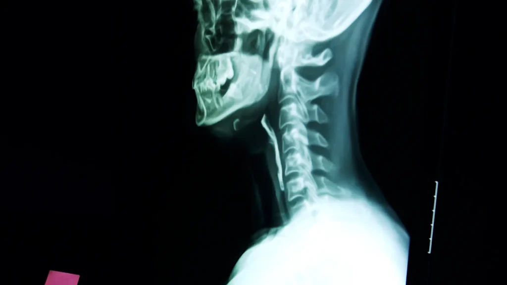 Lateral X-ray image of the cervical spine and skull showing detailed bone structure