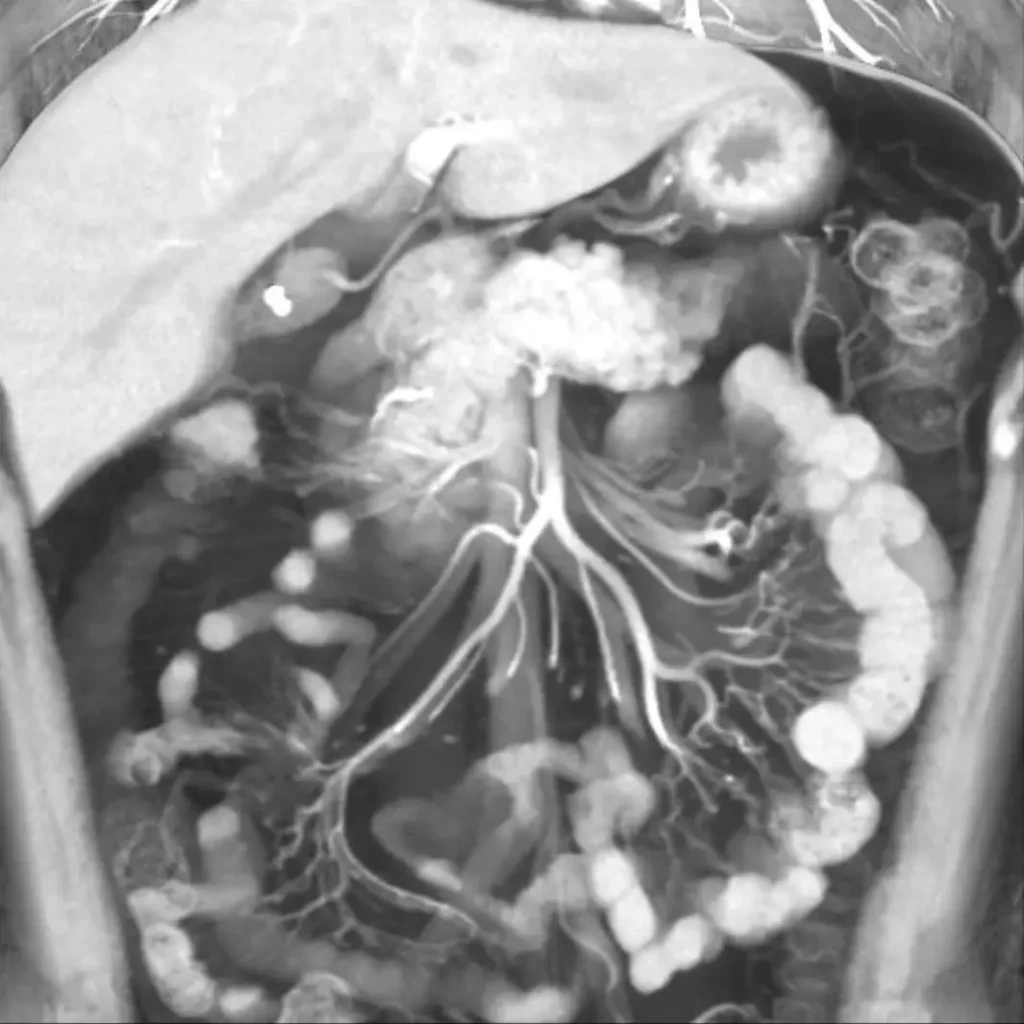 Coronal CT scan image of the abdomen showing the liver, stomach, and intestines