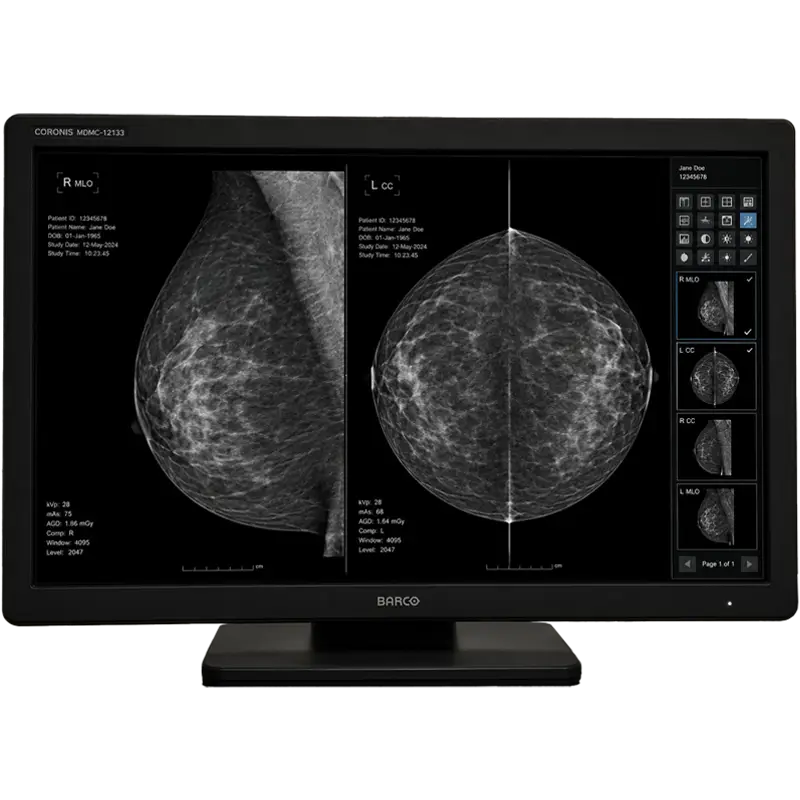 Barco Coronis diagnostic mammography monitor displaying bilateral breast imaging views