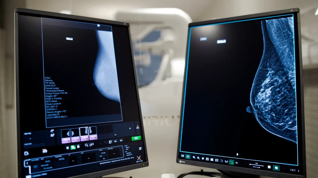 Two monitors displaying mammography images in an exam room, one showing exposure technique data and the other a full breast image