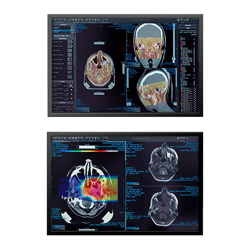 Two diagnostic monitors displaying MeVis radiology reading software with CT head scans in axial, sagittal, and coronal views