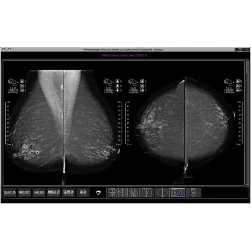 ThreePalm mammography viewer software showing four-view breast imaging with CAD markers and toolbar controls