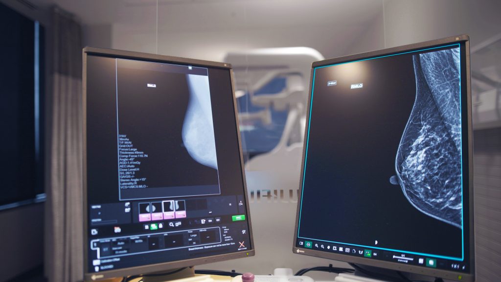A mammography workstation with dual diagnostic monitors displaying breast imaging studies side by side, representing the digital infrastructure and reading environment required to launch and operate a modern mammography program.